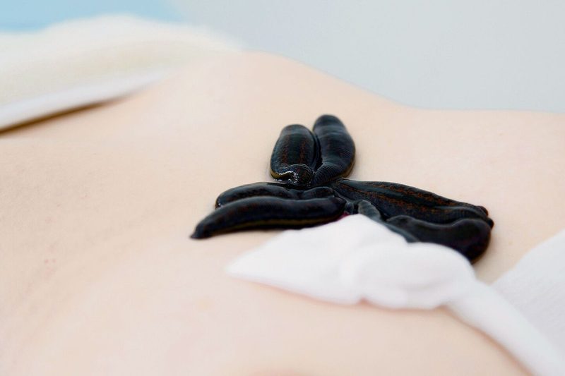 Die Blutegeltherapie punktet mit guten Erfolgen bei Entzündungen, akuten und chronischen Leiden.